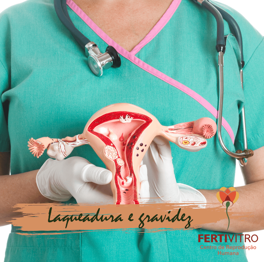 A Laqueadura ou ligadura tubária ou de trompas
