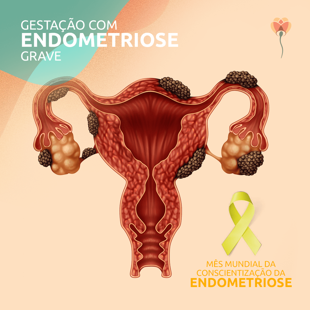 Mulher com endometriose grave pode ser mãe