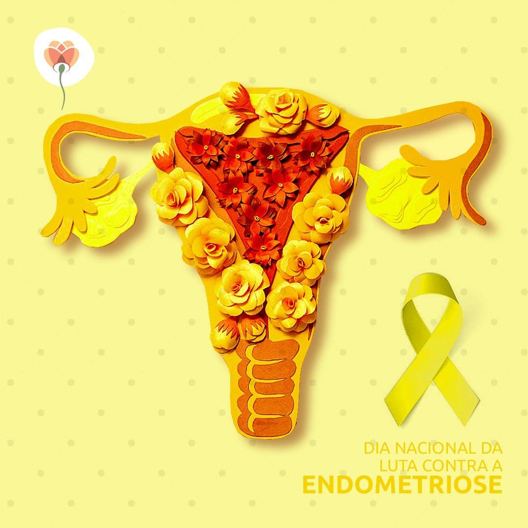 ENDOMETRIOSE E A FERTILIDADE FEMININA