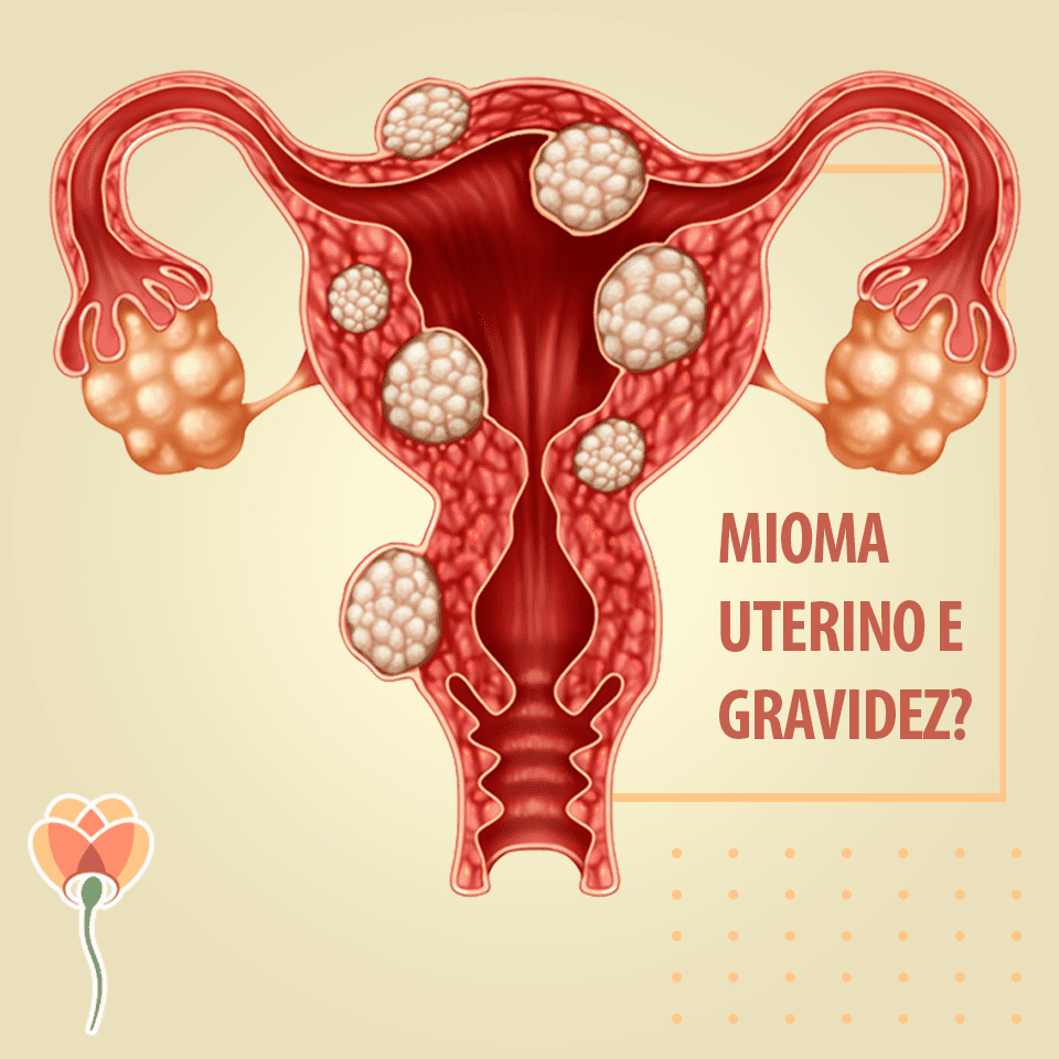 É possível engravidar com mioma uterino?