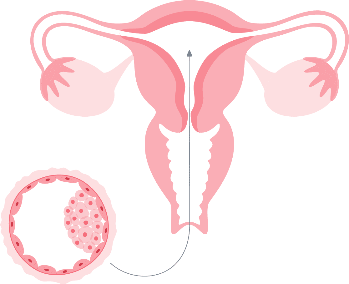 FIV transferência de embriões etapa 7 injeção intracitoplasmática de espermatozoide icsi