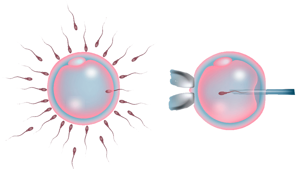 diferença entre FIV e ICSI injeção intracitoplasmática de espermatozoide icsi