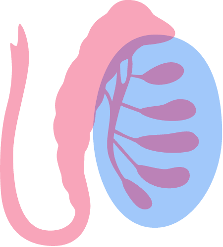 infertilidade masculina varicocele