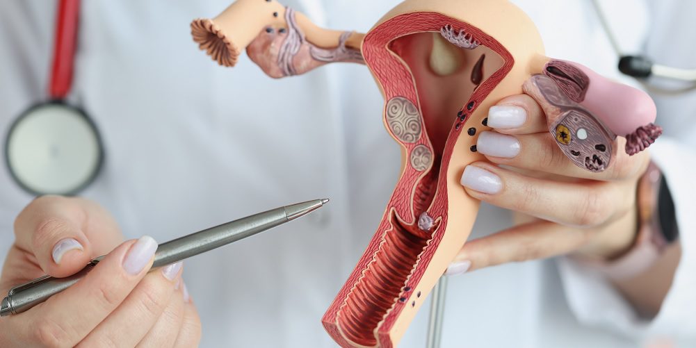 Miomas uterinos podem impedir a gravidez
